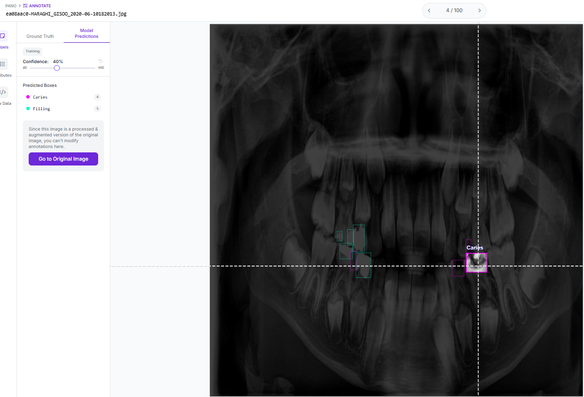 Example pano inference Caries and Filling